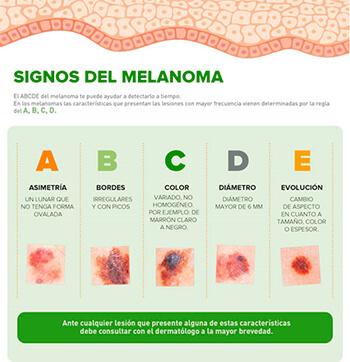 signos del melanoma  para detectar el cáncer de piel